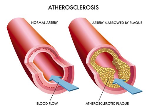 atherosclerosis-image